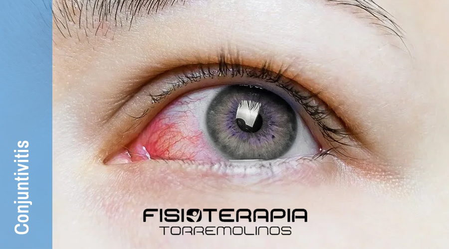 conjuntivitis (ojos rojos)