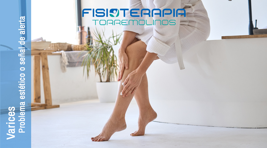 varices que son y tratamientos